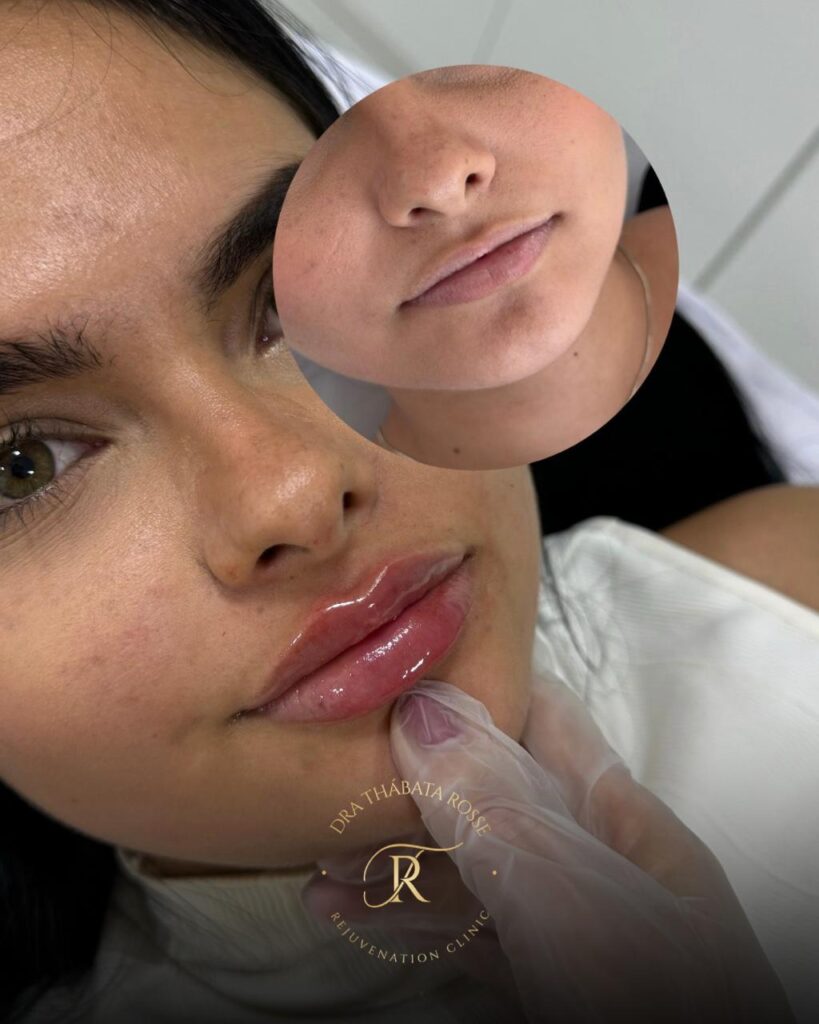 preenchimento labial