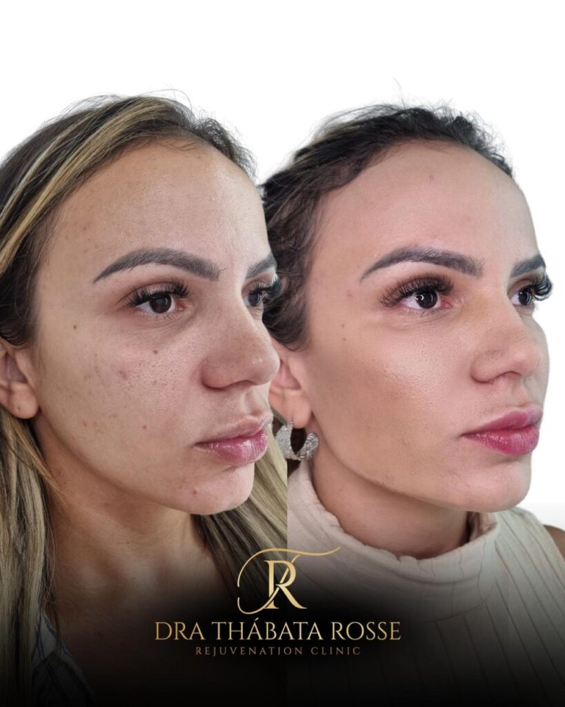 Rejuvenescimento Facial no Rio de Janeiro | Dra. Thábata Rosse